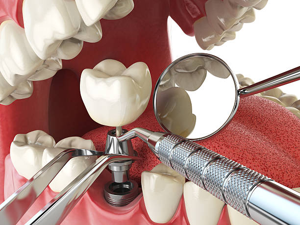 Best Emergency Dental Care for Abscessed Tooth in Riverside, MD